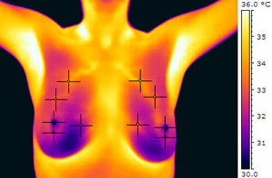 Cancer of the Left Breast